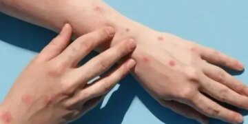 У РФ виявлено новий випадок мавпячої віспи: вірус починає поширюватися в країні