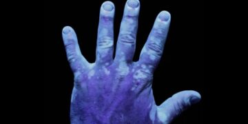 Вітіліго: чому люди з цією хворобою досі стикаються з осудом